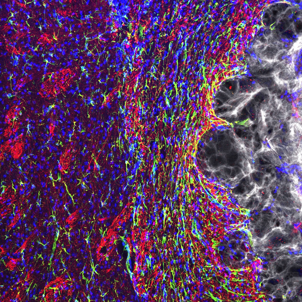 The image shows hydrogel that was injected into the stroke core. Axonal filaments are shown in red, astrocytes are dyed green, nuclei appear blue and the hydrogel is white.(Credit: Elias Sideris)