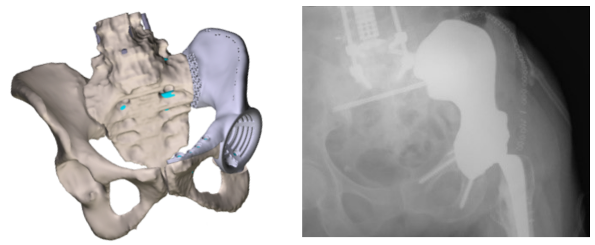 Patient-specific titanium hemipelvis implant to replace bone resected due to cancer.