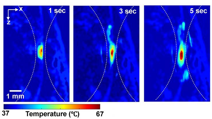 Photoacoustic imaging shows the absolute temperatures elevated by high-intensity focused ultrasound in small animal models at one, three and five seconds. 