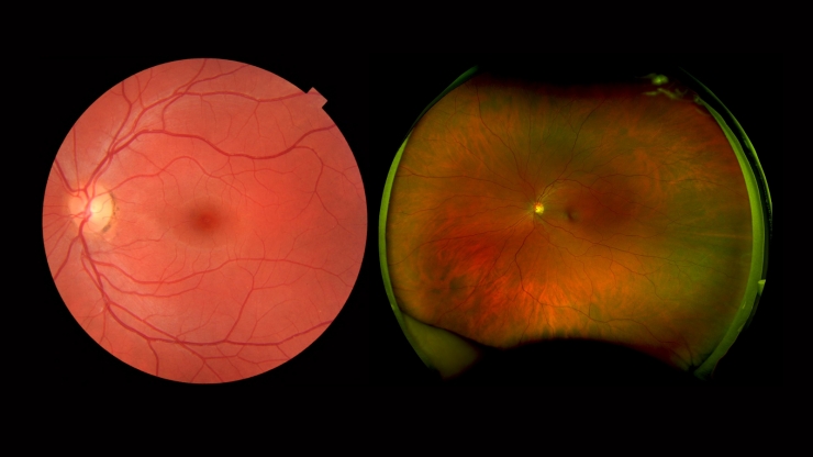Two images of a retina, side-by-side. The left is mostly reddish-pink while the right has many different colors and is more detailed
